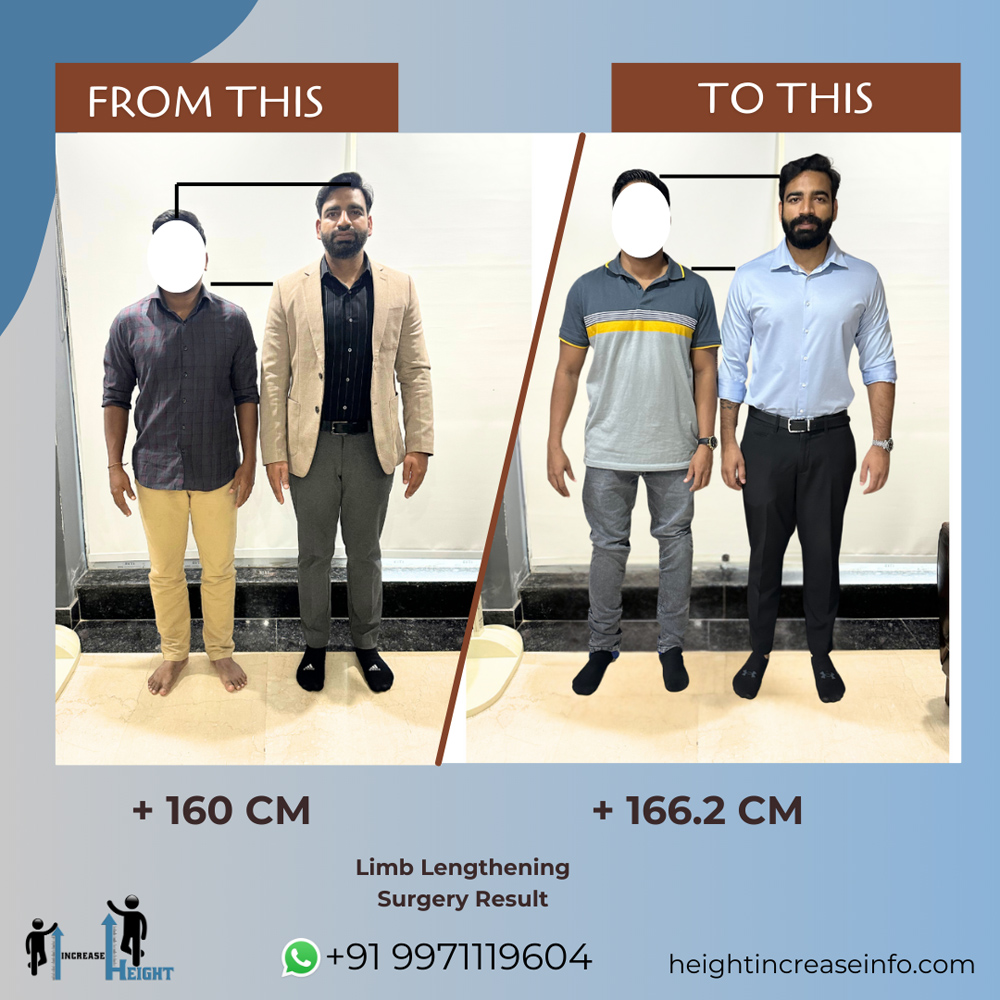 Limb Lengthening Result 1